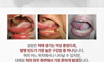 땡큐서울의원 - [하정훈 원장] 당신의 혀는 안녕하십니까? 설암의 위험 신호