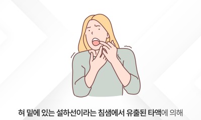 땡큐서울의원 - [강영 원장] 입안에 생긴 물혹 ‘하마종’, 재발 막으려면 제대로 치료해야 한다