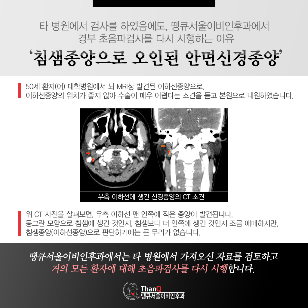 땡큐서울의원 - [땡큐서울의원 갑상선클리닉 _ 하정훈 원장 의학칼럼] 침샘 종양 수술, '안면신경 손상' 최소화가 중요한 이유