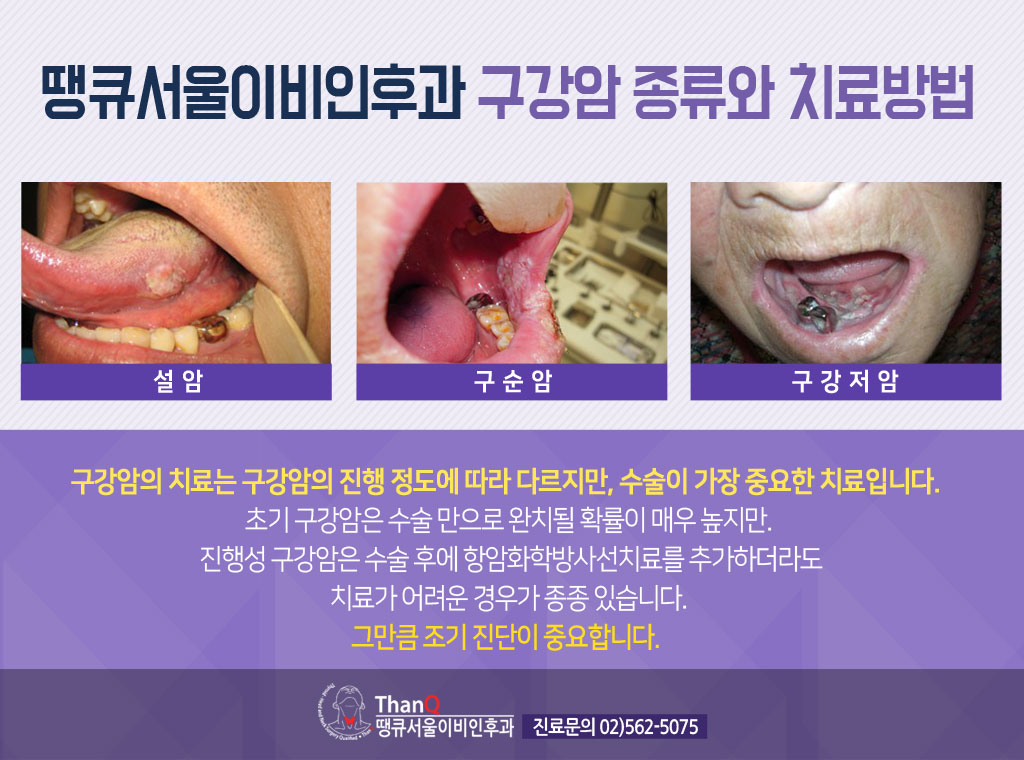땡큐서울의원 - [땡큐서울의원 두경부클리닉 _ 성명훈 원장 의학칼럼] 두경부암 검진이 필요한 경우