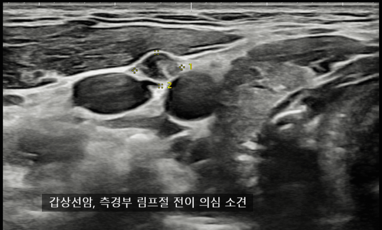땡큐서울의원 - [月刊 갑상선 vol.2] 갑상선염으로 오인된 갑상선 유두암 (빠르고 정확한 갑상선암 진단과 수술) (2025년 9월)