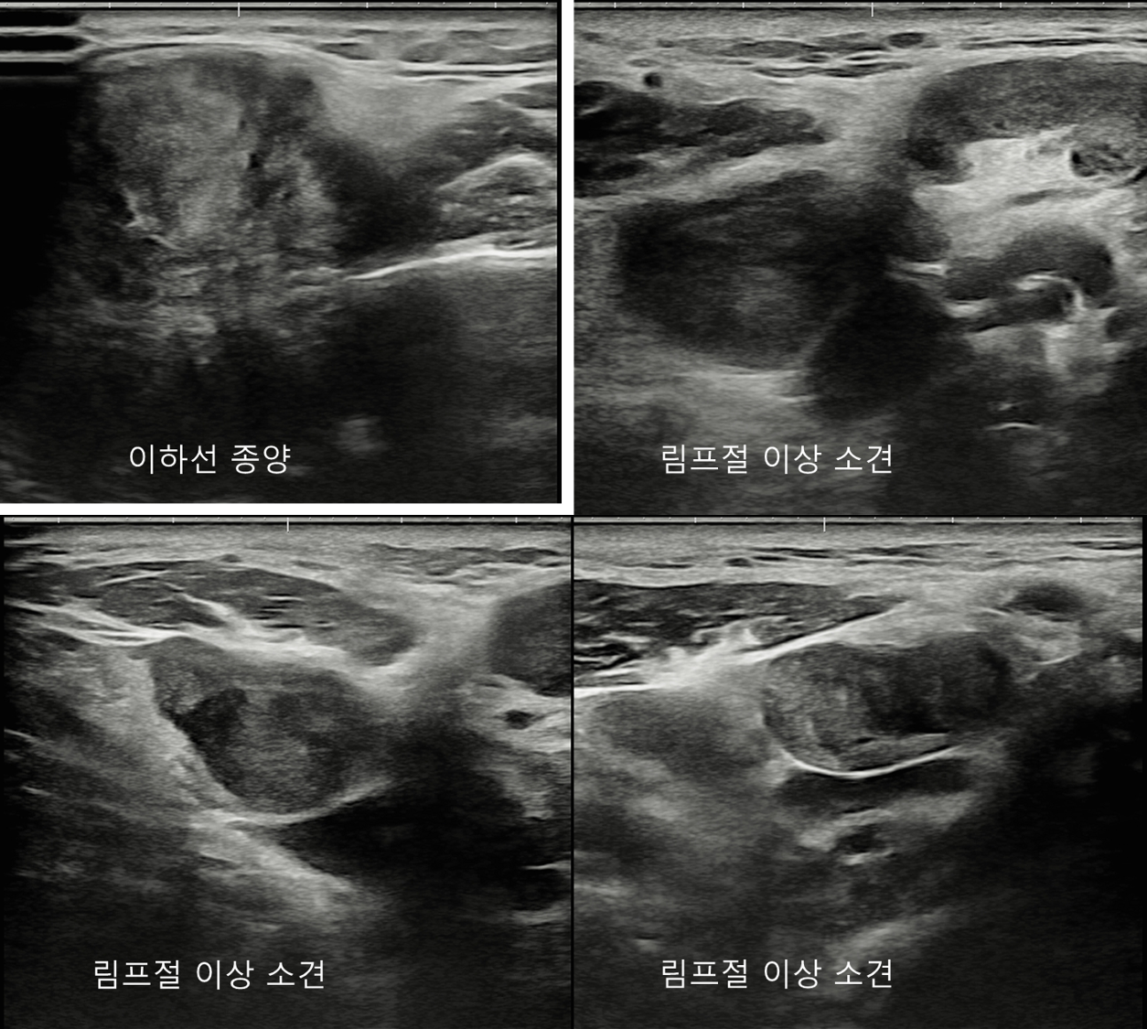 땡큐서울의원 - [月刊 두경부 vol.2] 고악성도 침샘암의 증상 (최근 수술 환자 4명의 진료일지) (2025년 9월)