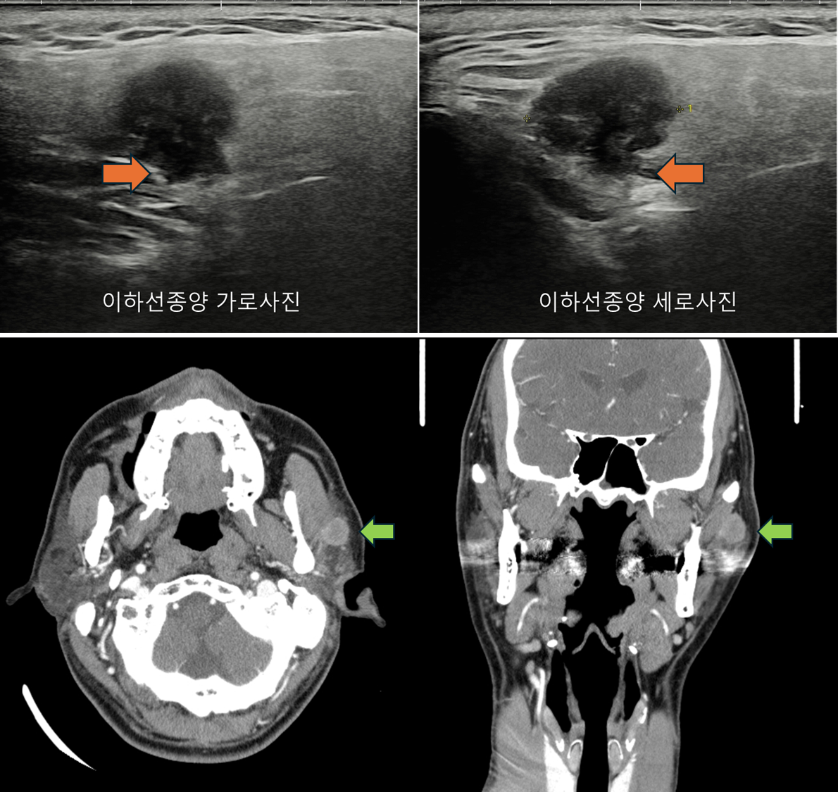 땡큐서울의원 - [月刊 두경부 vol.2] 고악성도 침샘암의 증상 (최근 수술 환자 4명의 진료일지) (2025년 9월)