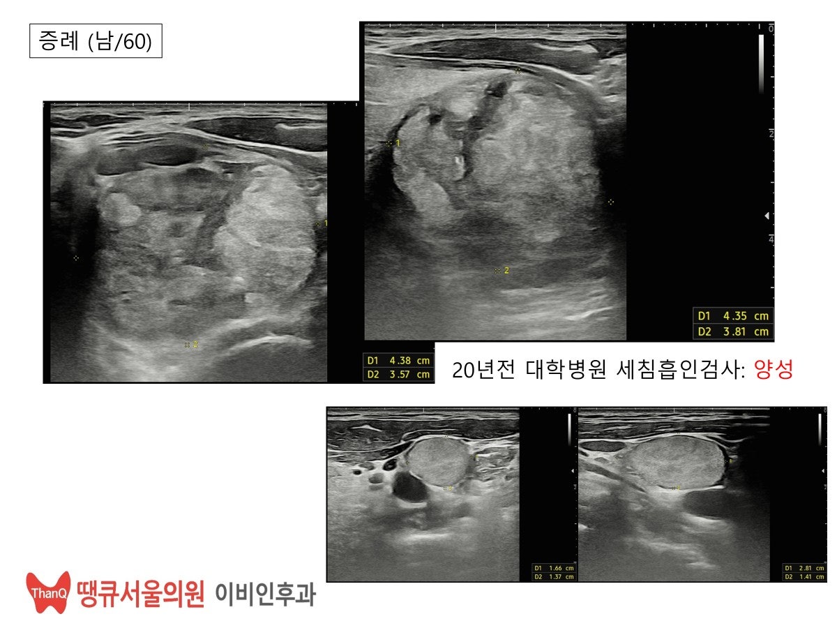땡큐서울의원 - [月刊 갑상선 vol.5] 진단이 어려운 갑상선 여포종양, 갖고 사는 것은 위험할 수 있어요 (2025년 12월)