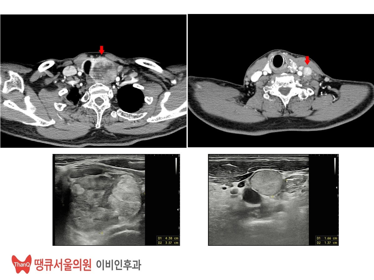 땡큐서울의원 - [月刊 갑상선 vol.5] 진단이 어려운 갑상선 여포종양, 갖고 사는 것은 위험할 수 있어요 (2025년 12월)