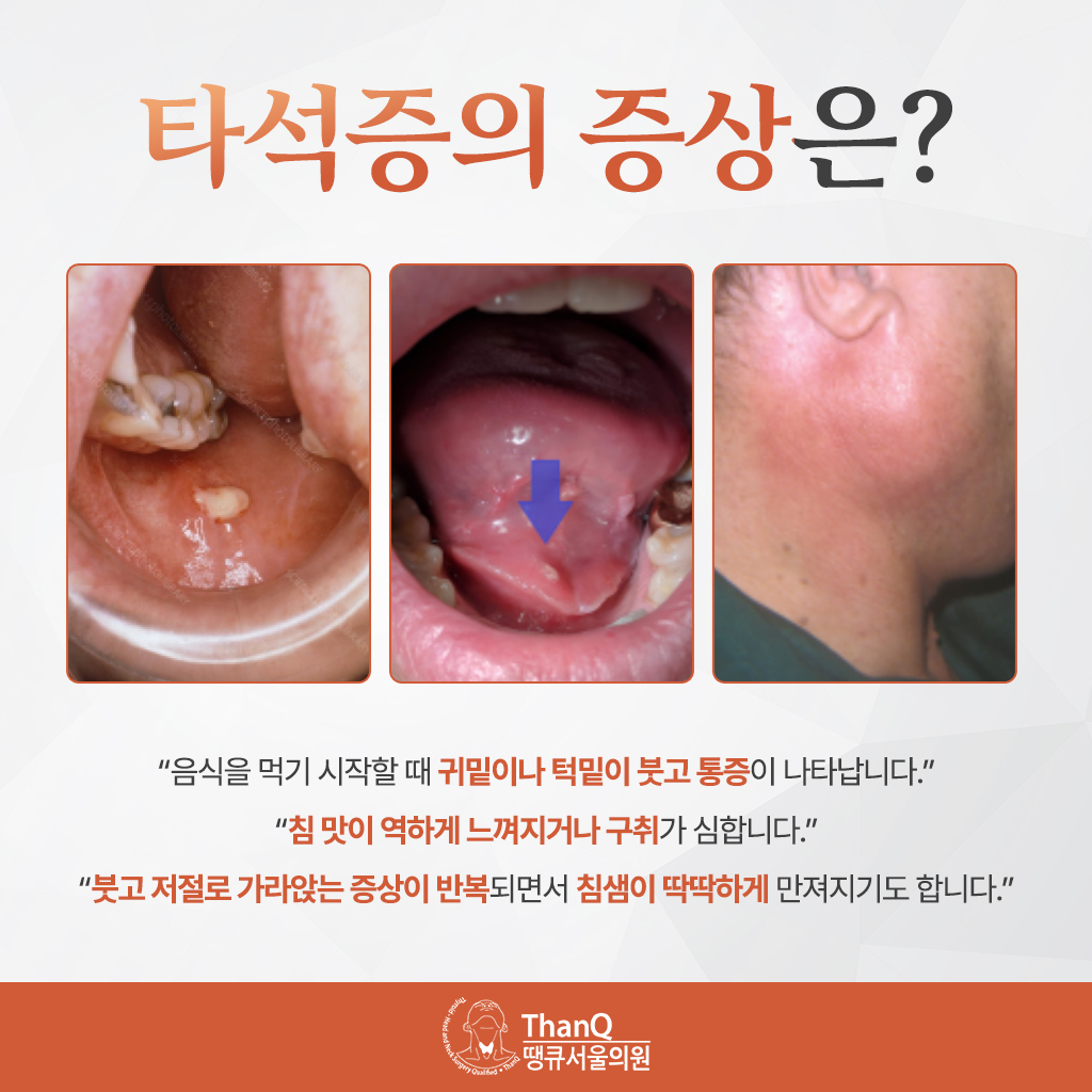땡큐서울의원 - [땡큐서울의원 침샘클리닉 _ 강영 원장 의학칼럼] 식사할 때마다 반복되는 턱밑 부종, '타석증'을 의심하라