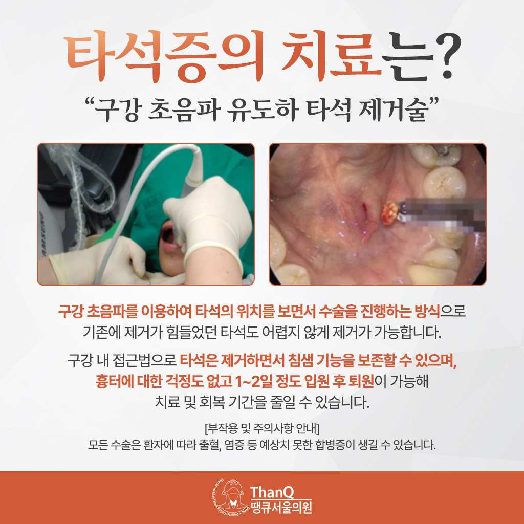 땡큐서울의원 - [땡큐서울의원 침샘클리닉 _ 강영 원장 의학칼럼] 식사할 때마다 반복되는 턱밑 부종, '타석증'을 의심하라