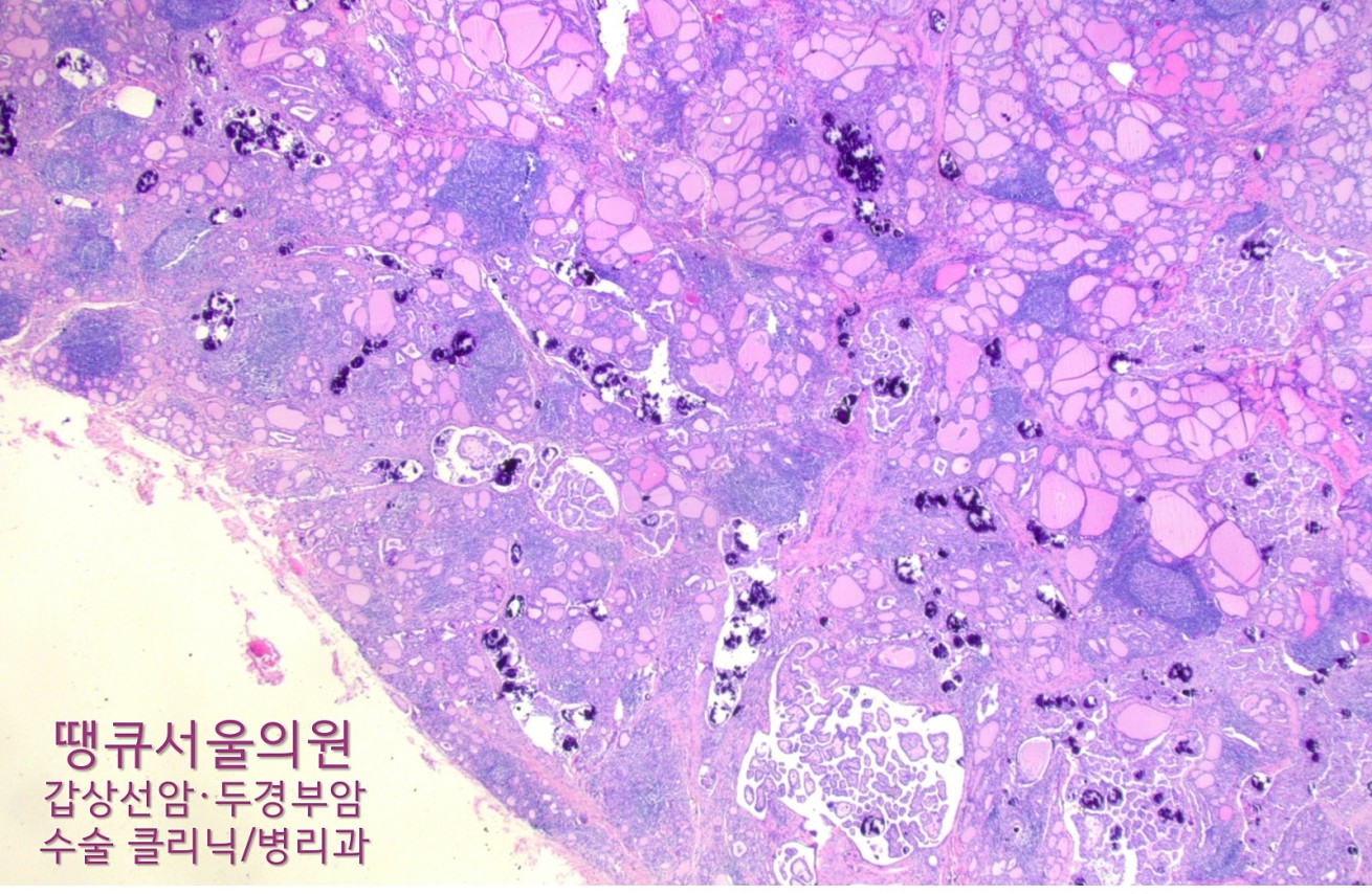 땡큐서울의원 - [月刊 갑상선 vol.2] 갑상선염으로 오인된 갑상선 유두암 (빠르고 정확한 갑상선암 진단과 수술) (2025년 9월)