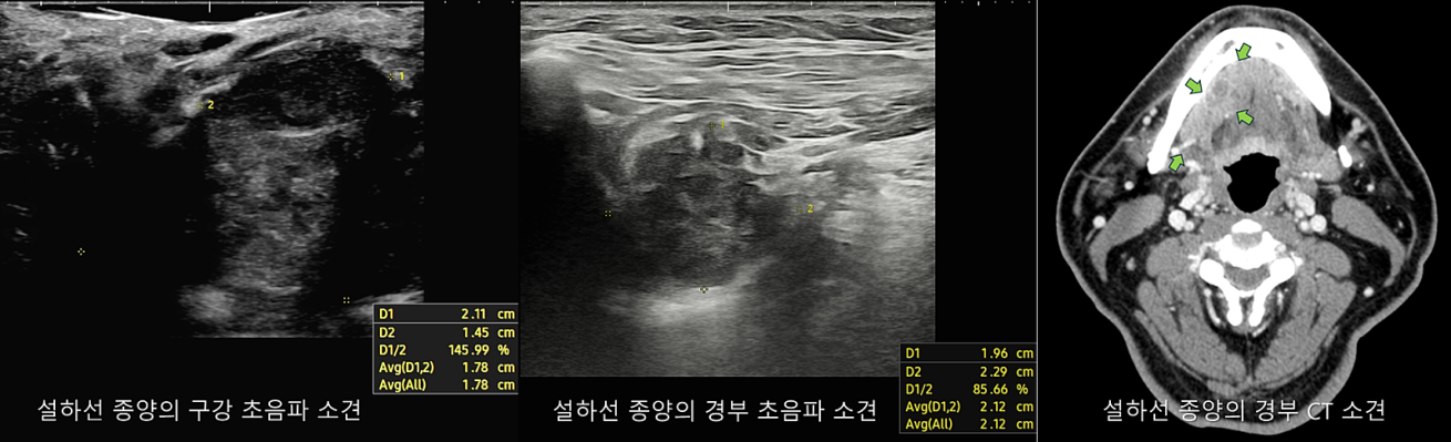 땡큐서울의원 - [月刊 두경부 vol.2] 고악성도 침샘암의 증상 (최근 수술 환자 4명의 진료일지) (2025년 9월)