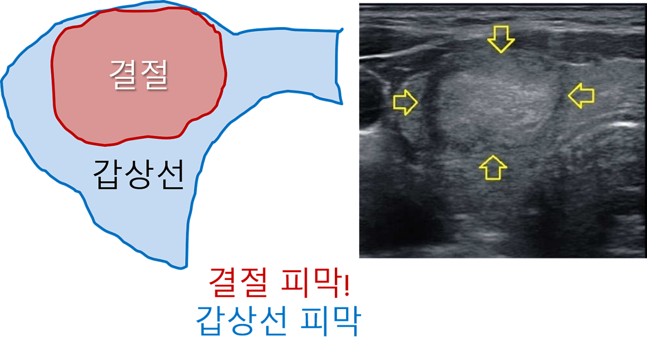 땡큐서울의원 - [月刊 갑상선 vol.5] 진단이 어려운 갑상선 여포종양, 갖고 사는 것은 위험할 수 있어요 (2025년 12월)