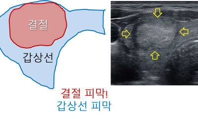 땡큐서울의원 - [月刊 갑상선 vol.5] 진단이 어려운 갑상선 여포종양, 갖고 사는 것은 위험할 수 있어요 (2025년 12월)