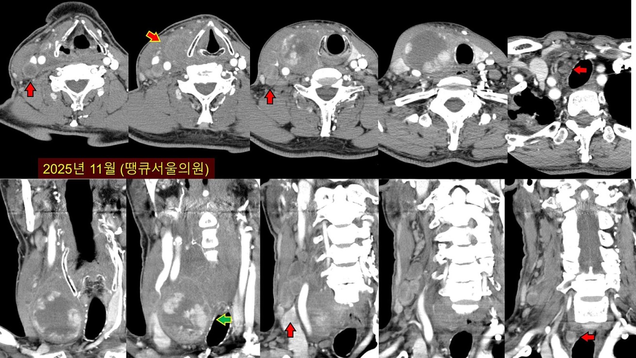 땡큐서울의원 - [月刊 갑상선 vol.5] 진단이 어려운 갑상선 여포종양, 갖고 사는 것은 위험할 수 있어요 (2025년 12월)