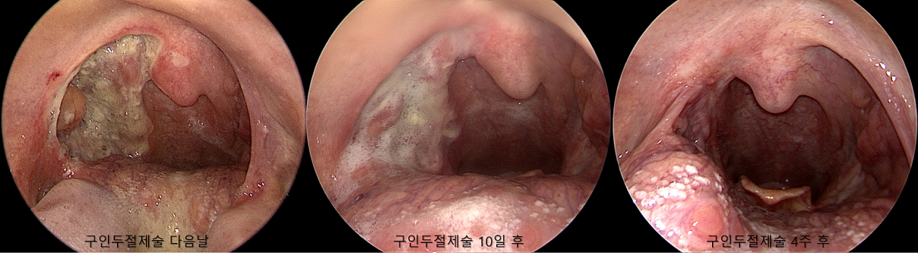땡큐서울의원 - [月刊 두경부 vol.1] 편도암 수술 4인4색 (4명 환자의 진료일지) (2025년 8월)