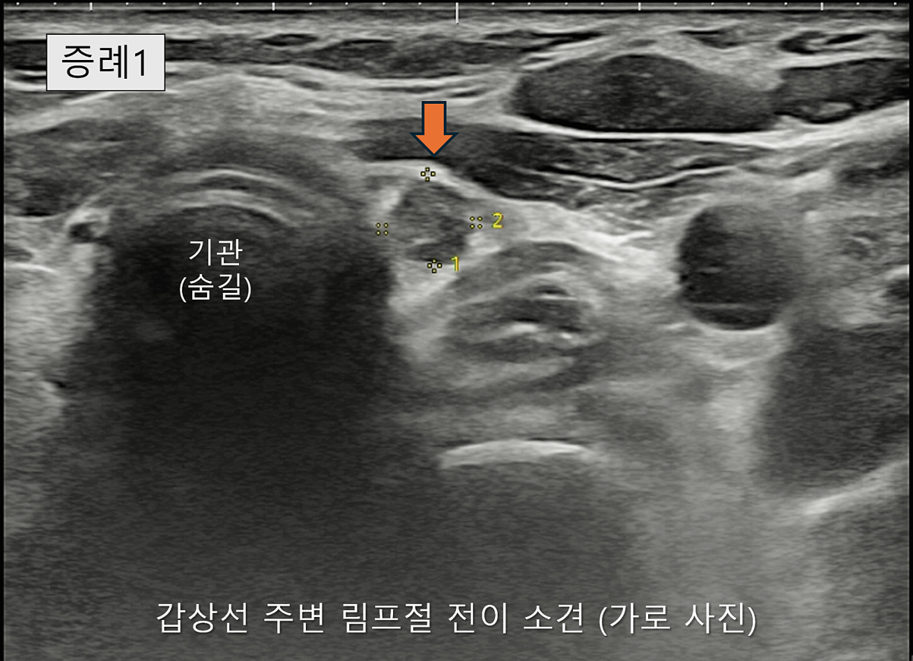 땡큐서울의원 - [月刊갑상선 vol.8] 갑상선암 전이의 복병, 중심경부 림프절 (2026년 03월)