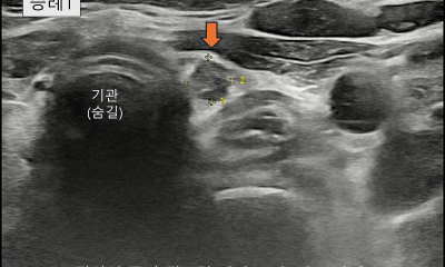 땡큐서울의원 - [月刊갑상선 vol.8] 갑상선암 전이의 복병, 중심경부 림프절 (2026년 03월)