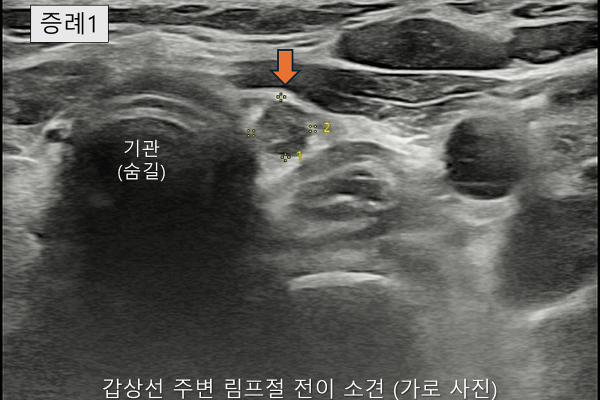 땡큐서울의원 - [月刊갑상선 vol.8] 갑상선암 전이의 복병, 중심경부 림프절 (2026년 03월)