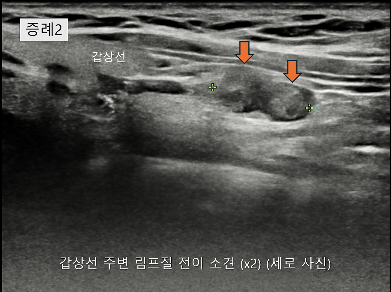 땡큐서울의원 - [月刊갑상선 vol.8] 갑상선암 전이의 복병, 중심경부 림프절 (2026년 03월)