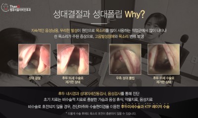 땡큐서울의원 - 쉰 목소리 방치하면 굳은살로, 성대결절의 증상과 치료