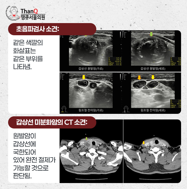 땡큐서울의원 - 갑상선 미분화암 수술(갑상선 역형성암 수술, 미분화 갑상선암 수술)