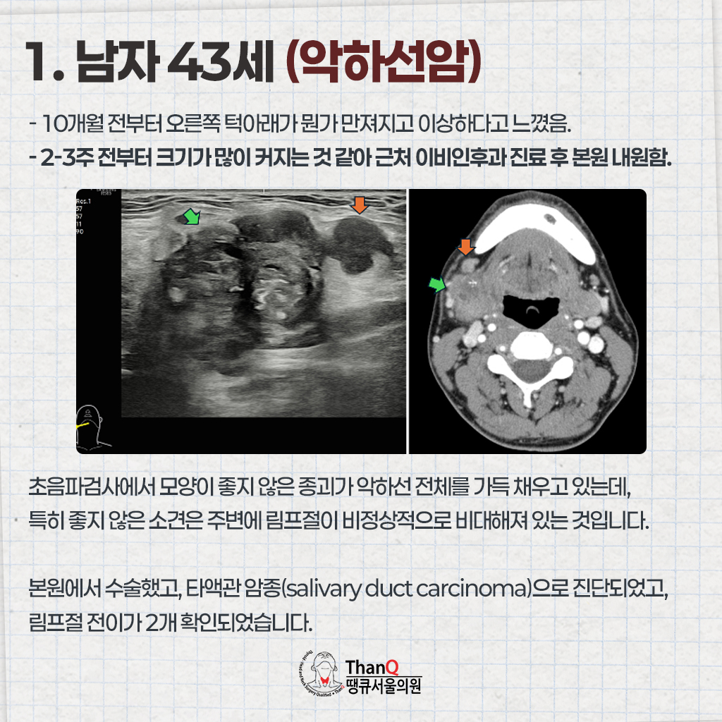 땡큐서울의원 - 땡큐서울의원의 침샘암 사례