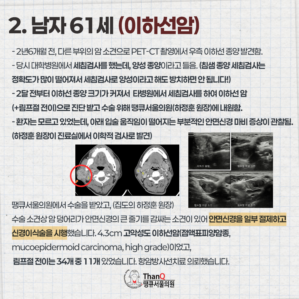 땡큐서울의원 - 땡큐서울의원의 침샘암 사례