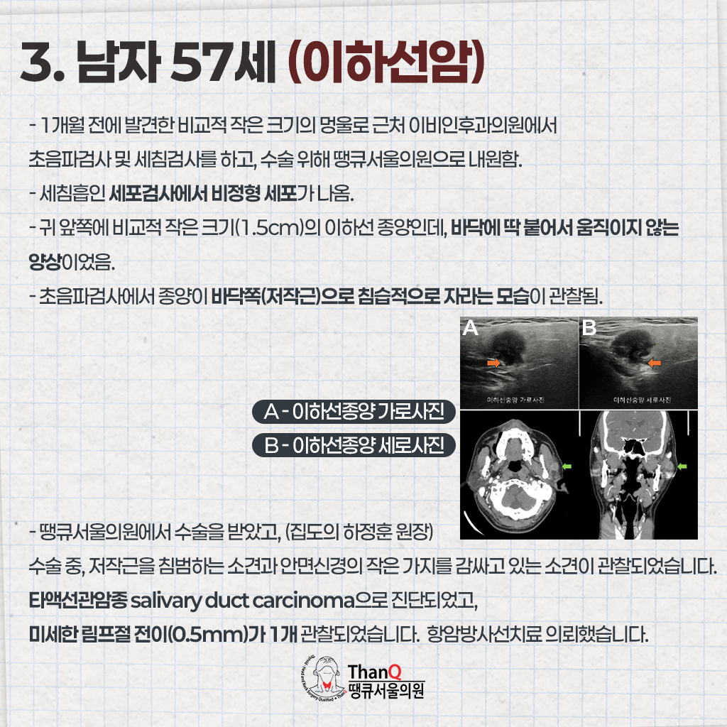 땡큐서울의원 - 땡큐서울의원의 침샘암 사례