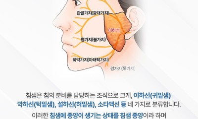 땡큐서울의원 - [땡큐서울의원 이하선종양클리닉_ 하정훈 원장 의학칼럼] 귀밑에 생긴 이하선종양, 수술에서 안면신경 보존이 중요한 이유