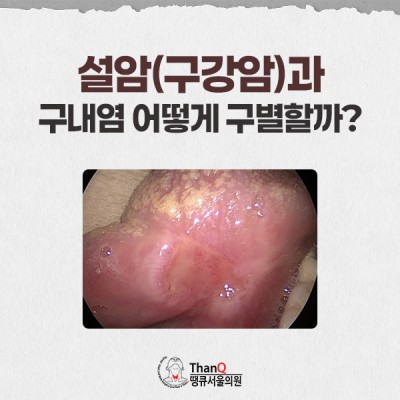 땡큐서울의원 - 설암 원인과 조기진단 중요성