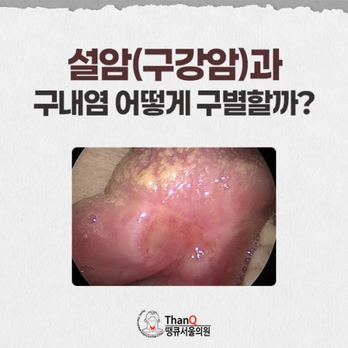 땡큐서울의원 - 설암 원인과 조기진단 중요성
