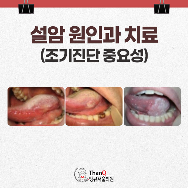 땡큐서울의원 - 설암 원인과 치료 - 조기 진단 중요성