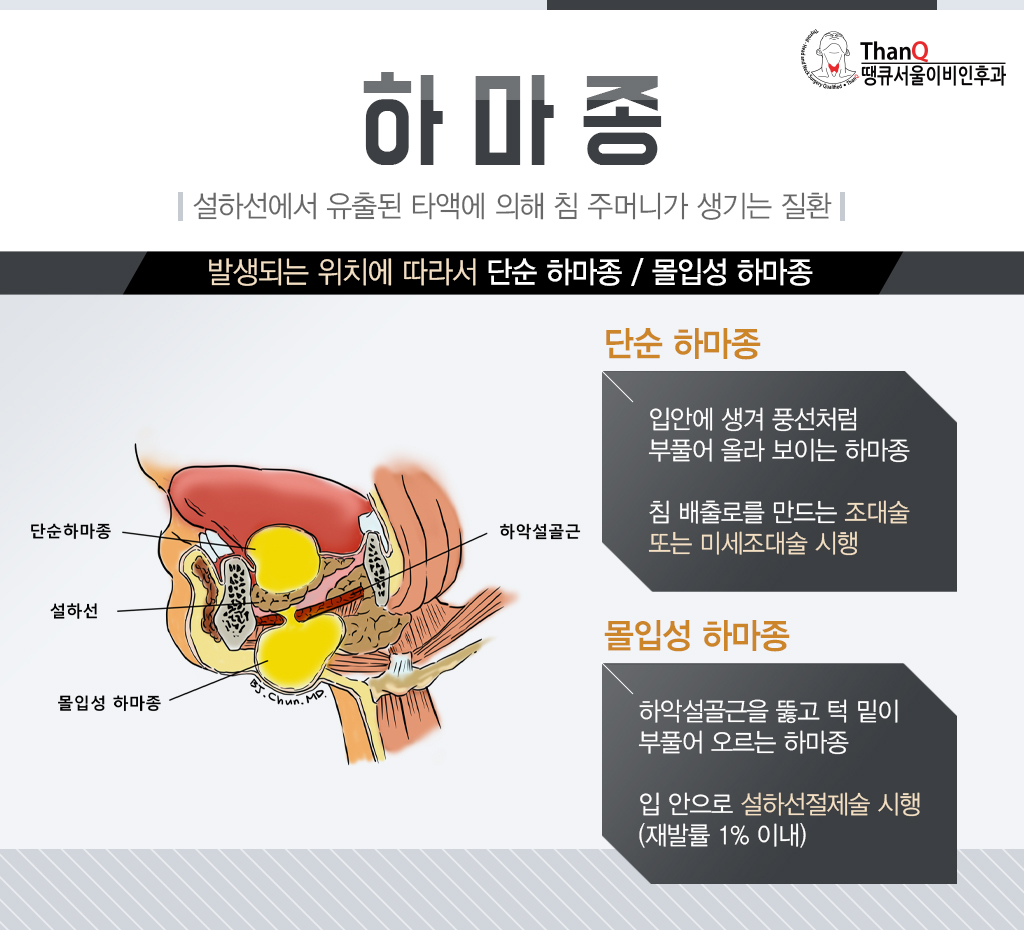 땡큐서울의원 - [땡큐서울의원 침샘질환클리닉_ 강영 원장 의학칼럼] 혀 밑에 물혹처럼 생긴 하마종, 그냥 두어도 될까