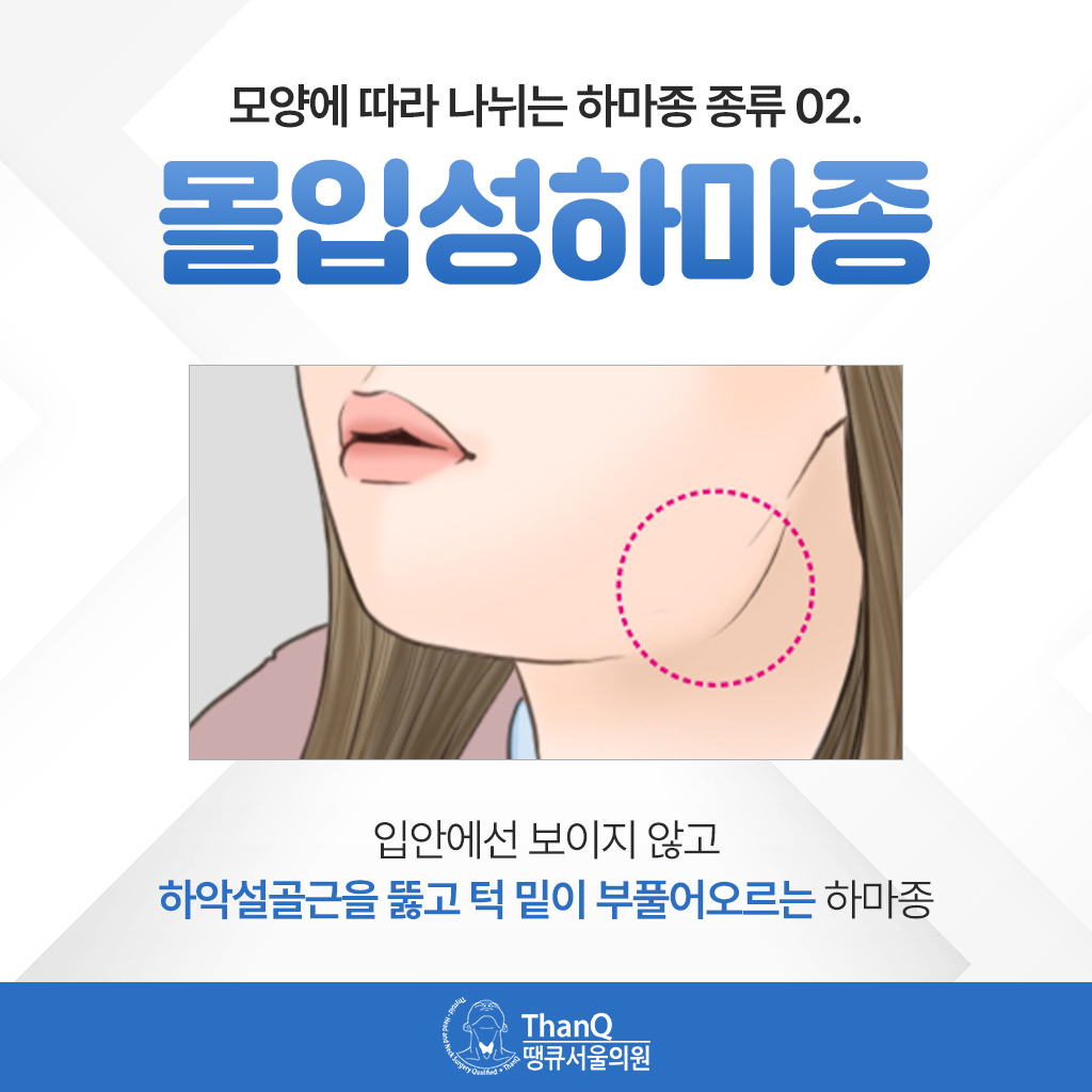 땡큐서울의원 - [땡큐서울의원 침샘질환클리닉_ 강영 원장 의학칼럼] 혀 밑에 물혹처럼 생긴 하마종, 그냥 두어도 될까