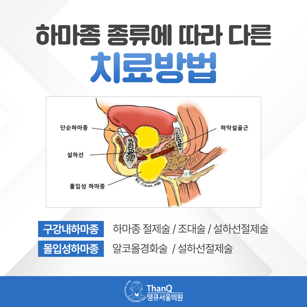 땡큐서울의원 - [땡큐서울의원 침샘질환클리닉_ 강영 원장 의학칼럼] 혀 밑에 물혹처럼 생긴 하마종, 그냥 두어도 될까
