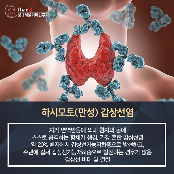 땡큐서울의원 - [땡큐서울의원 갑상선클리닉_ 송영기 원장 의학칼럼] 갑상선염 증상, 유형에 따라 달라져… 놓쳐서는 안 되는 이상 신호는?