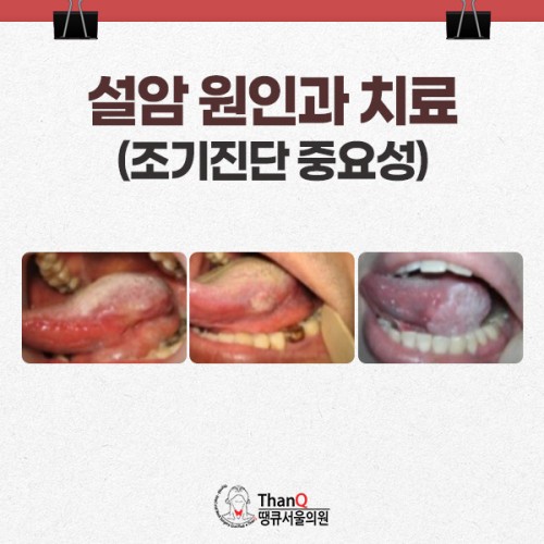 땡큐서울의원 - 설암 원인과 치료 - 조기 진단 중요성