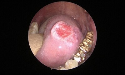 땡큐서울의원 - 설암은 어떻게 생겼나요?