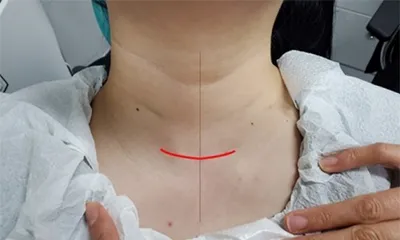 땡큐서울의원 갑상선전절제 상태 - 중앙 절개 (5~5.5cm)