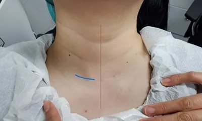 땡큐서울의원 갑상선반절제 상태 - 측면 절개 (2.5~3cm)