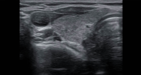 땡큐서울의원 갑상선암 갑상선반절제 상태