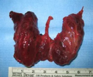 땡큐서울의원 갑상선암 갑상선전절제 상태