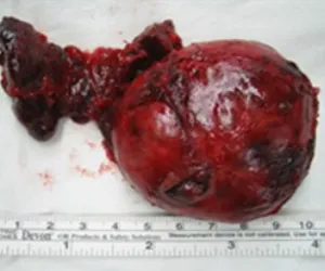 땡큐서울의원 갑상선암 갑상선여포암