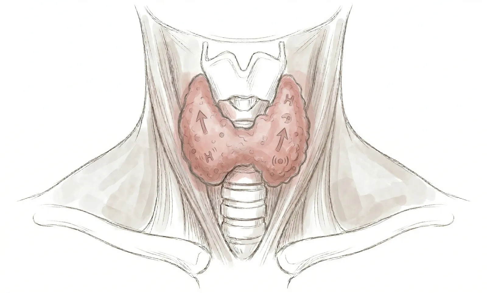 땡큐서울의원 갑상선기능항진증 일러스트
