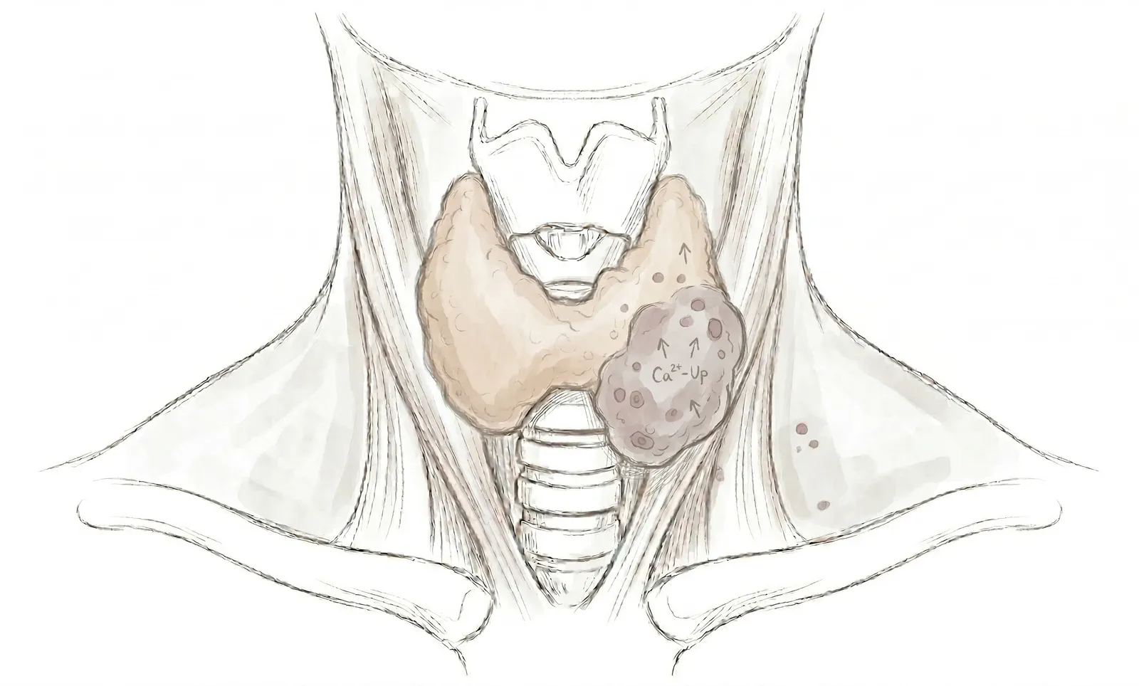 땡큐서울의원 부갑상선기능항진증 일러스트