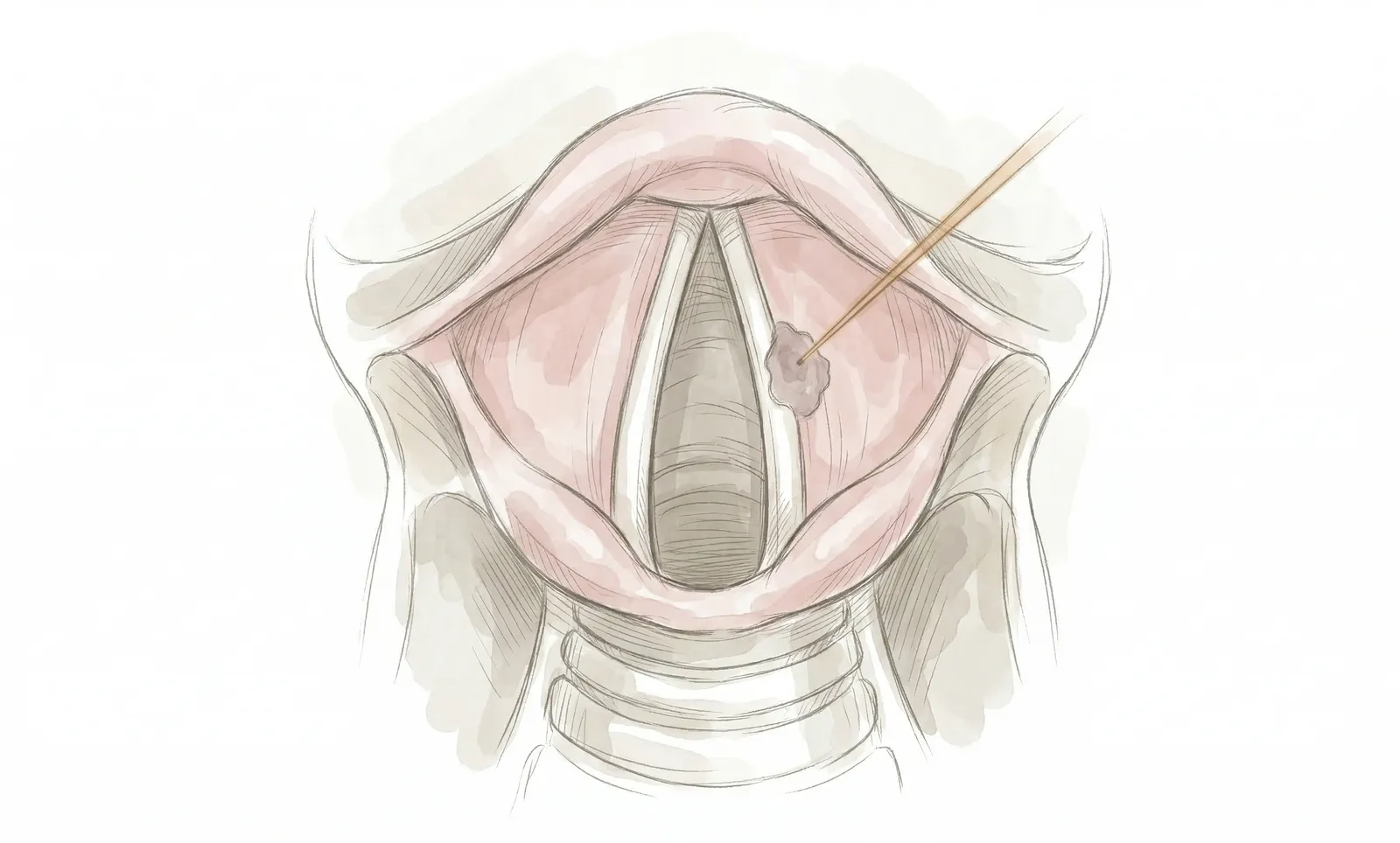 땡큐서울의원_KTP레이저수술