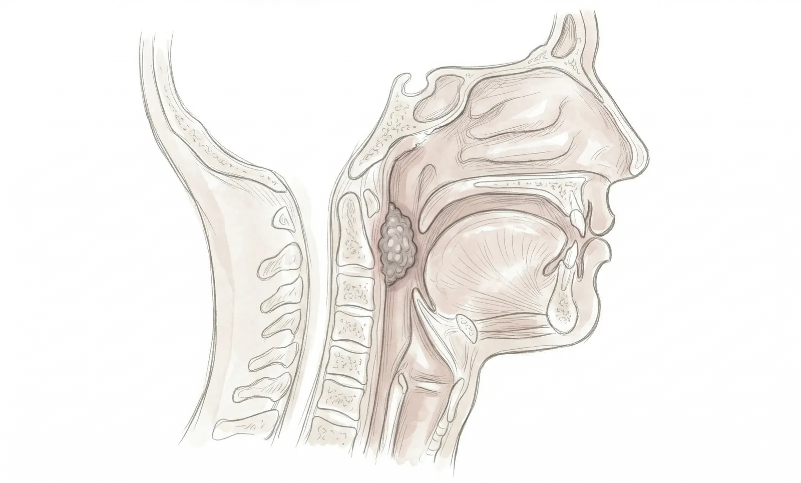 땡큐서울의원 인두암