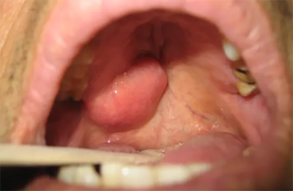 땡큐서울의원_소침샘종양