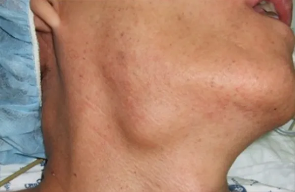 땡큐서울의원_악하선침샘종양