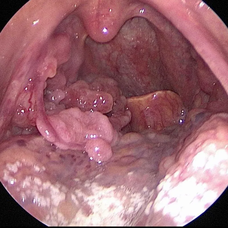 땡큐서울의원_구인두암수술전