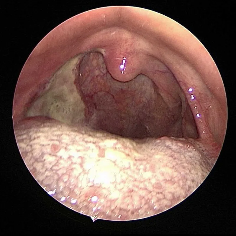 땡큐서울의원_구인두암수술후