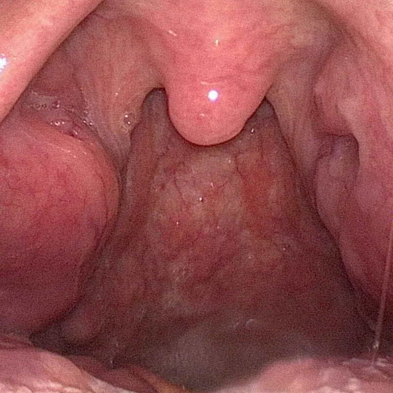 땡큐서울의원_구인두암림프절전이